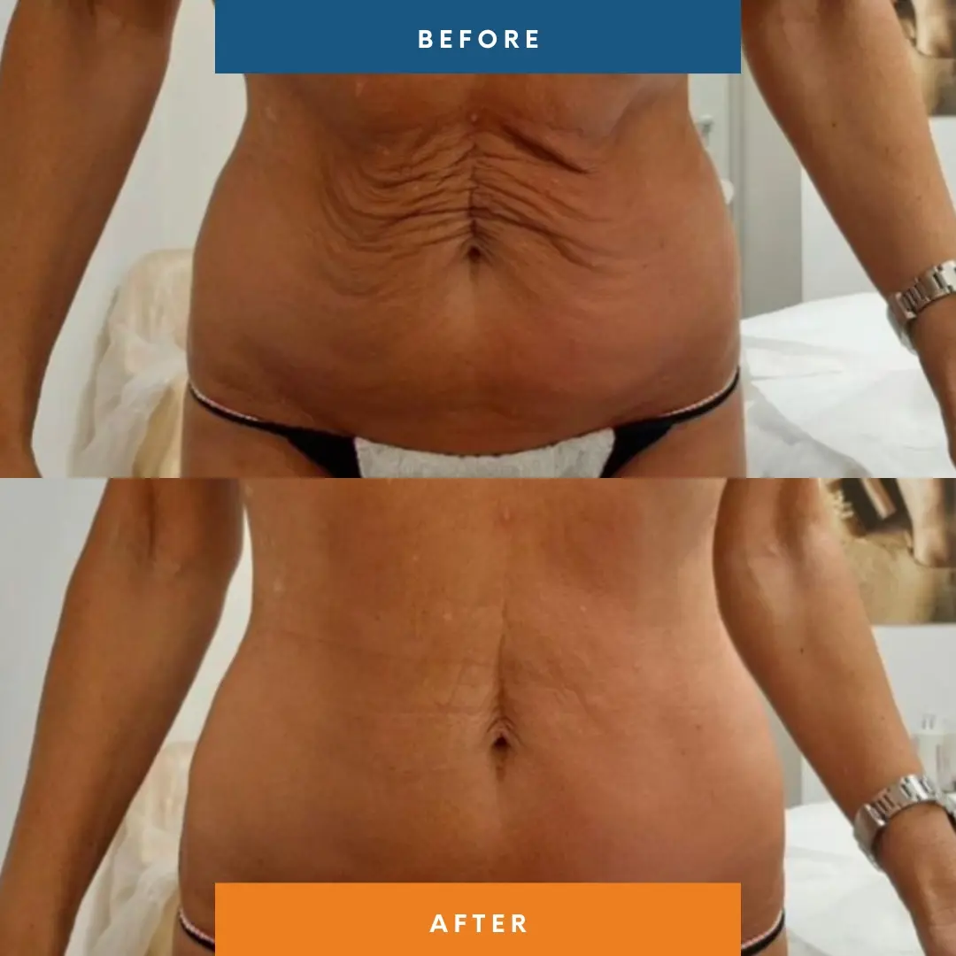 T-Shape 2 Body Contouring Packages - Image 2